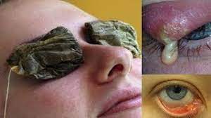 Check spelling or type a new query. Will Tea Bags Get Rid Of A Stye Youtube
