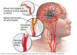 Maybe you would like to learn more about one of these? Stroke Symptoms And Causes Mayo Clinic