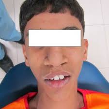 Second stage of CAD-CAM development: direct scan with intraoral scanner... 