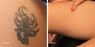 The cost of laser tattoo removal is based on the type of laser being used, the level of expertise of the operator, the size and complexity of a tattoo, and the geographic location of the laser removal center. Thigh Tattoo Removal Results Case Study Removery