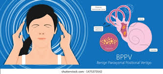 Image result for Canalith Repositioning Procedure