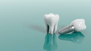 Image result for dental implant