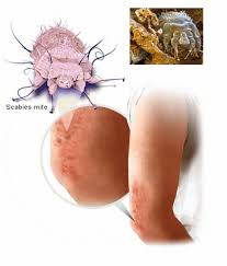 Image result for Sarcoptes scabiei life cycle