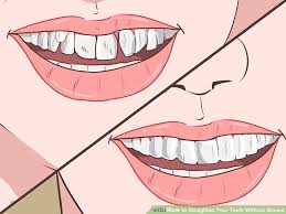 How to reduce braces pain wikihow. How To Straighten Teeth Without Braces At Home In Hindi Teethwalls