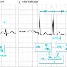 Pdf What Clinicians Should Know About The Qt Interval