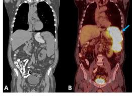 Image result for Splenomegaly