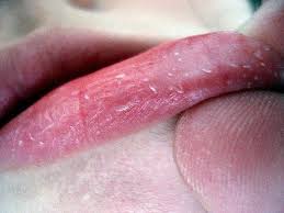 Oleh karena itu, lapisan bibir mudah sekali kering dan retak. Mengapa Bibir Kering Dan Kulit Punca Rawatan