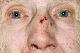 Maybe you would like to learn more about one of these? Broken Nose Nhs