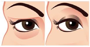 Natural Remedy For Sagging Eyelids You Will See Results In 2 Minutes Droopy Eyes Drooping Eyelids Beauty Treatments