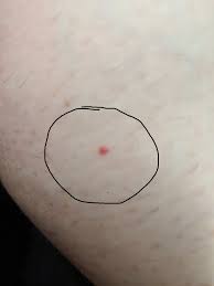 The face is delicate, and excess heat may lead to broken blood vessels. Red Skin Bumps Look Like Blood Vessels Hitting The Surface Why Are They How To Get Rid Of Them Dermatologyquestions
