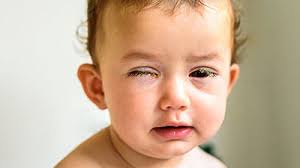 Image result for Conjunctivitis