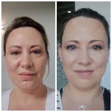 How bells palsy happen because of the anesthesia,