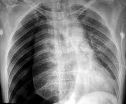 Image result for Open Pneumothorax