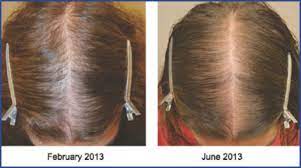 You could be on the birth control for many months—or even years—before you start to notice hair loss. Medical Therapy For Female Pattern Hair Loss Fphl Hair Transplant Forum International