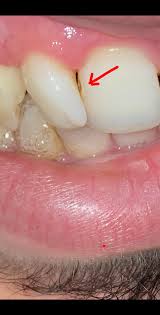 His staff always makes sure you know the cost involved. I Noticed A Hole Between My Front Teeth Is This A Cavity Or A Stain I Honestly Don T Know If It Was There Before It S Kind Of Hidden In Between I Have