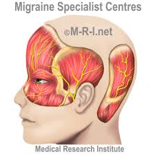 Diagram Of Migraine Headaches Catalogue Of Schemas