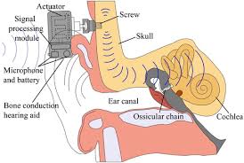 Image result for Ossicular Chain Disruption