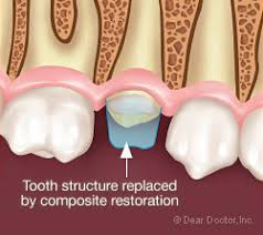 How to remove a broken tooth. Saving Broken Teeth Dear Doctor Dentistry Oral Health