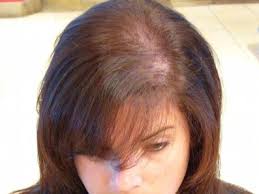 Irreversible hair loss is caused by excessive inflammation that leads to scarring. Family Magazine Hair Loss Vitamin Deficiency