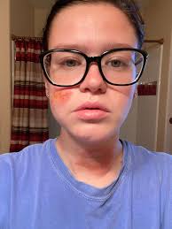 Severe poison ivy allergy treatment options