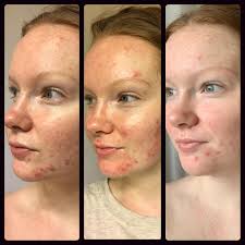 I've still been getting pimples here and there (mostly when i eat dairy), but overall my skin is drastically improved! Differin Purge Week 4 My Routine For Starting On Tretinoin Retin A Cream With Video