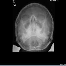 How To Tell If Your Child S Nose Is Broken Patient S Lounge