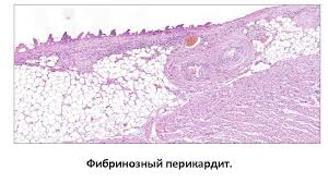 Дифференциальная диагностика счс проводится с гранулематозом вегенера, гиперэозинофильным синдромом, узелковым полиартериитом. æ—©ä¸Šå¥½ Revmaticheskie Bolezni é¢¨æ¿•æ€§ç–¾ç—… Zabolevaniya Soedinitelnoj Tkani