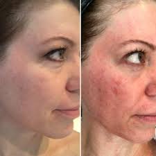 Microderm md review 2020 : My Experience And Before And After Photos With Microdermabrasion Microneedling And Dermaplaning My Full Review O Dermaplaning Microneedling Microdermabrasion