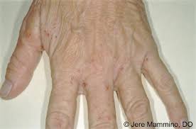 Scabies is a transmissible ectoparasite skin infection caused by tiny mites of the species sarcoptes scabiei, with the disease characterized by intense itching (pruritus), a rash, and secondary infection, as well as superficial burrows where mites tunnel under the skin of their hosts. Scabies American Osteopathic College Of Dermatology Aocd