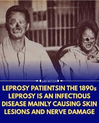 Image result for Leprosy