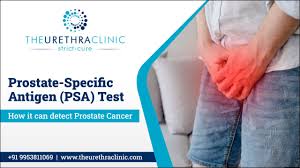 Image result for Prostate Specific Antigen