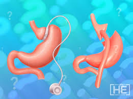 Was Kostet Eine Magenbypass Operation Wie Verandert Sich Der Preis Dr He Obesity Clinic