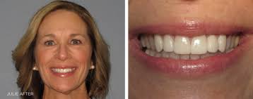 A Brighter, More Even Smile