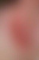 Dä international archive 25/2018 tuberculosis cutis luposa (lupus vulgaris). Tuberculosis Cutis Luposa Altmeyers Encyclopedia Department Dermatology