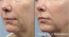 Forma - Wrinkles and Fine Lines - Skin Tightening