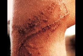 Portuguese Man Of War Sting Picture Image On Medicinenet Com