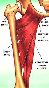 A groin strain refers to a set of five different muscles, also known as the adductors, that help adduct (bring in towards your midline) the thigh and stabilize the hip. Bodyworks Adductor Injuries
