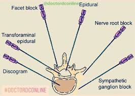 Important Different Types Of Spinal Injections Please Tag And Share With Friends Anesthesia Anesthesiologist Injec Biologia Estudio Columnas