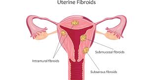 Uterine cancer symptoms include unusual vaginal bleeding. What To Expect If You Have Uterine Fibroids Preferred Vascular Group