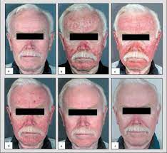 68% of users who reviewed this medication reported a positive effect, while 16% reported a negative effect. New Approaches To The Treatment Of Actinic Keratosis Springerlink