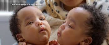 Twin brothers born conjoined celebrate 1st birthday after separation  surgery