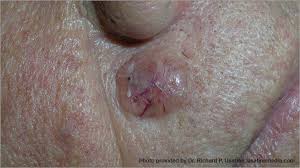 There are many types of skin cancer, each of which can look different on the skin. Skin Cancer Pictures Photos Pictures Of Skin Cancer