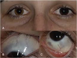 Image result for melanosis sclera