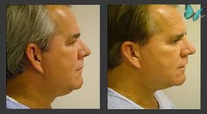 Facelift Beverly Hills