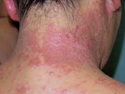 According to colourists, dyeing your hair on your period could heighten scalp irritation. Allergy To Paraphenylenediamine Dermnet Nz