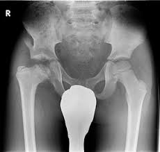 A better outcome is defined as a round femoral. Huftgelenkserkrankungen Morbus Perthes Epiphysenfugenabrutsch Grosstes Kommunales Krankenhaus In Nrw
