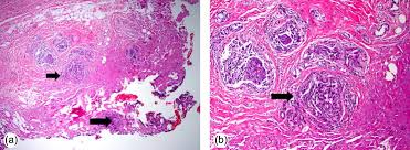 Then under diagnosis the report states: Surgical Margins In Breast Conservation Sciencedirect