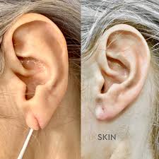 It affects people of all races, genders and ages, which is why it's absolutely critical for americans to learn about. Split Earlobe Repair Expert Skin Surgery Plastic Surgery