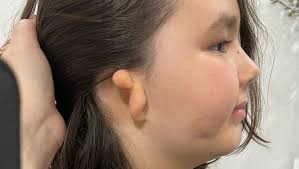 Fundraiser by Tiffany Oliver : Zach's 3D Ear Reconstruction