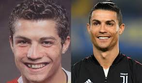 See more ideas about cristiano ronaldo young, cristiano ronaldo, ronaldo. Celebrities With Braces Before And After Famous Brace Faces